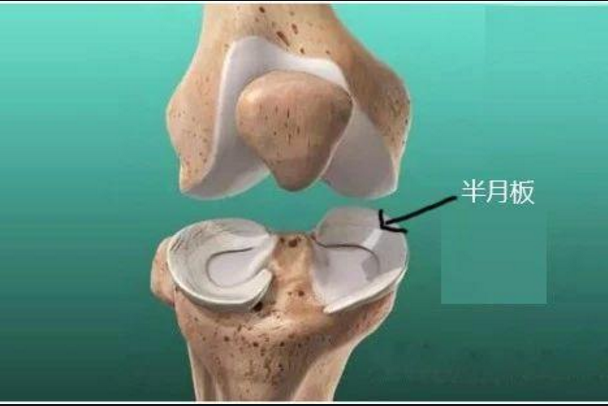 半月板损伤的我,还能运动吗?