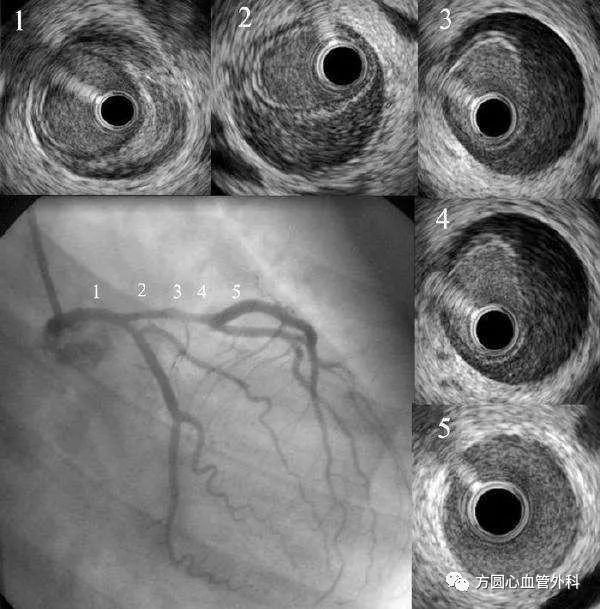 认识自发性冠状动脉夹层
