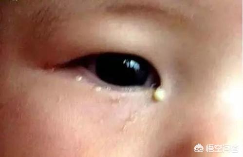 两个多月的宝宝眼睛一直有分泌物怎么办？