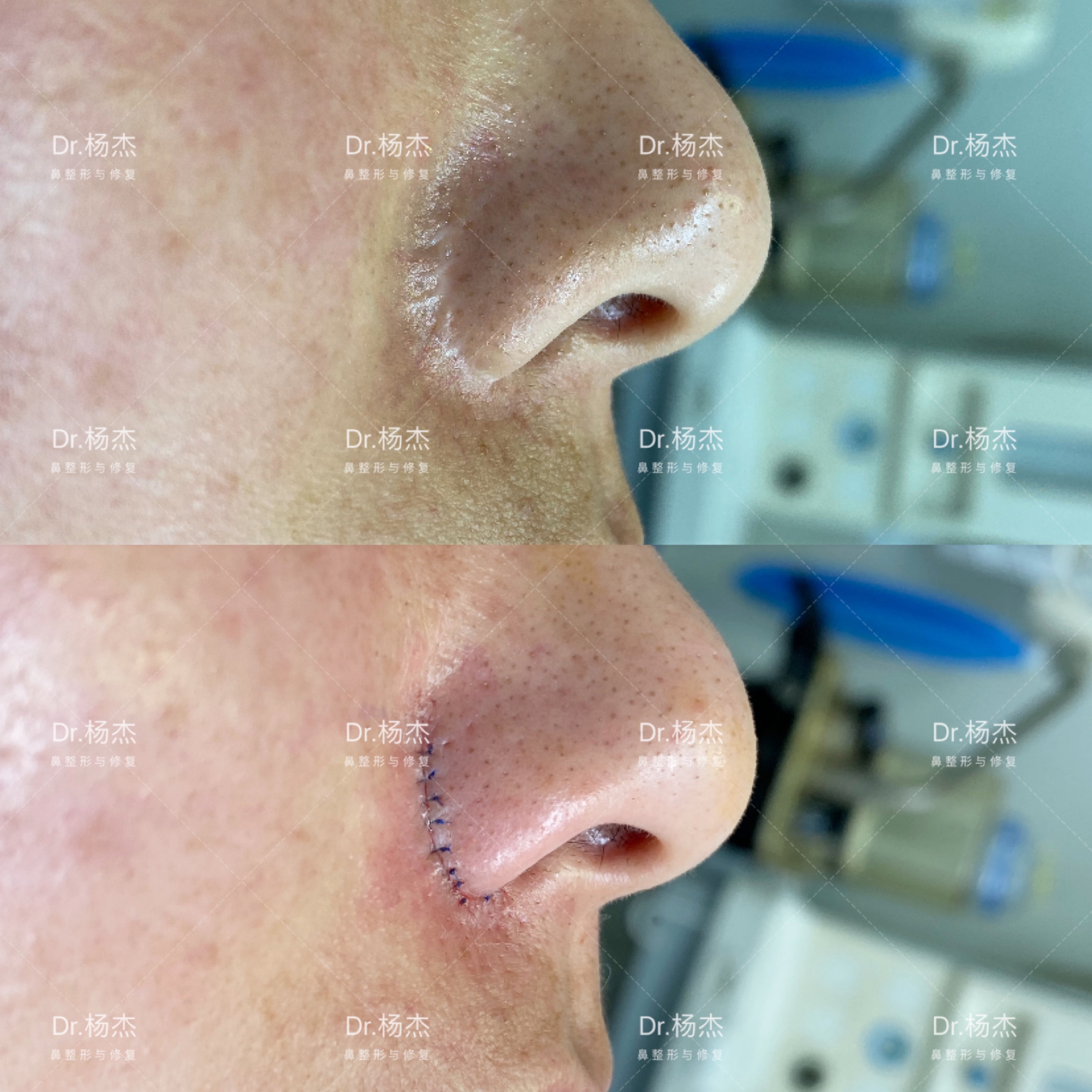 鼻翼缩小疤痕修复