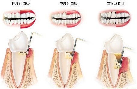 成人牙齒矯正有沒有年齡限制