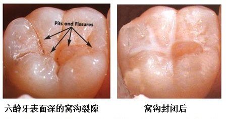 什么是六龄齿,六龄齿长出来还会换吗?