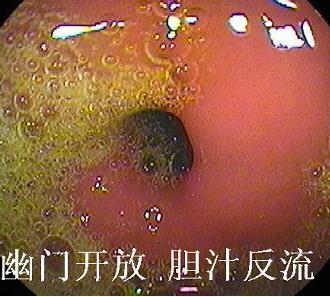 胆汁反流性胃炎的诊断和治疗纯干货