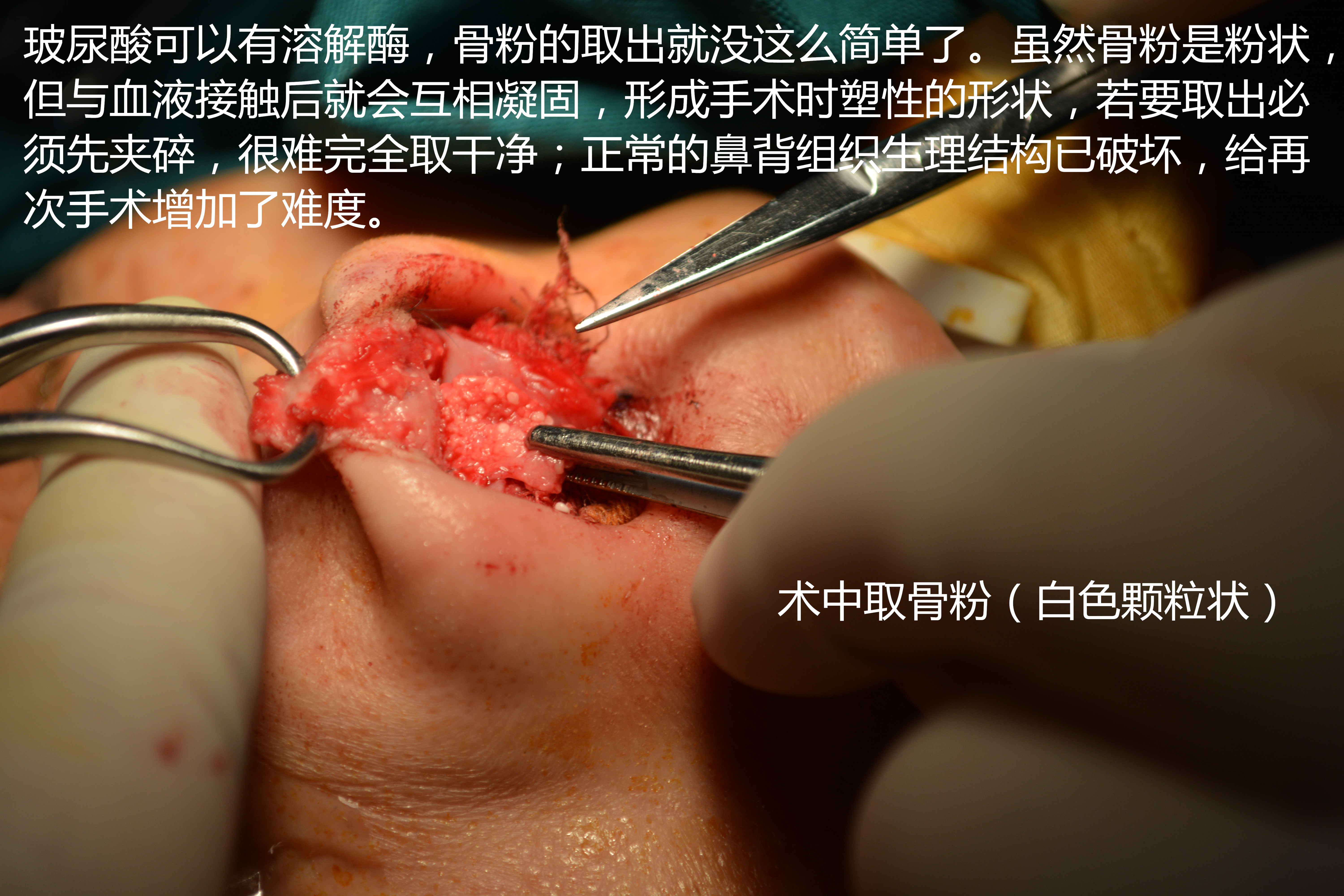 可怕的注射物骨粉