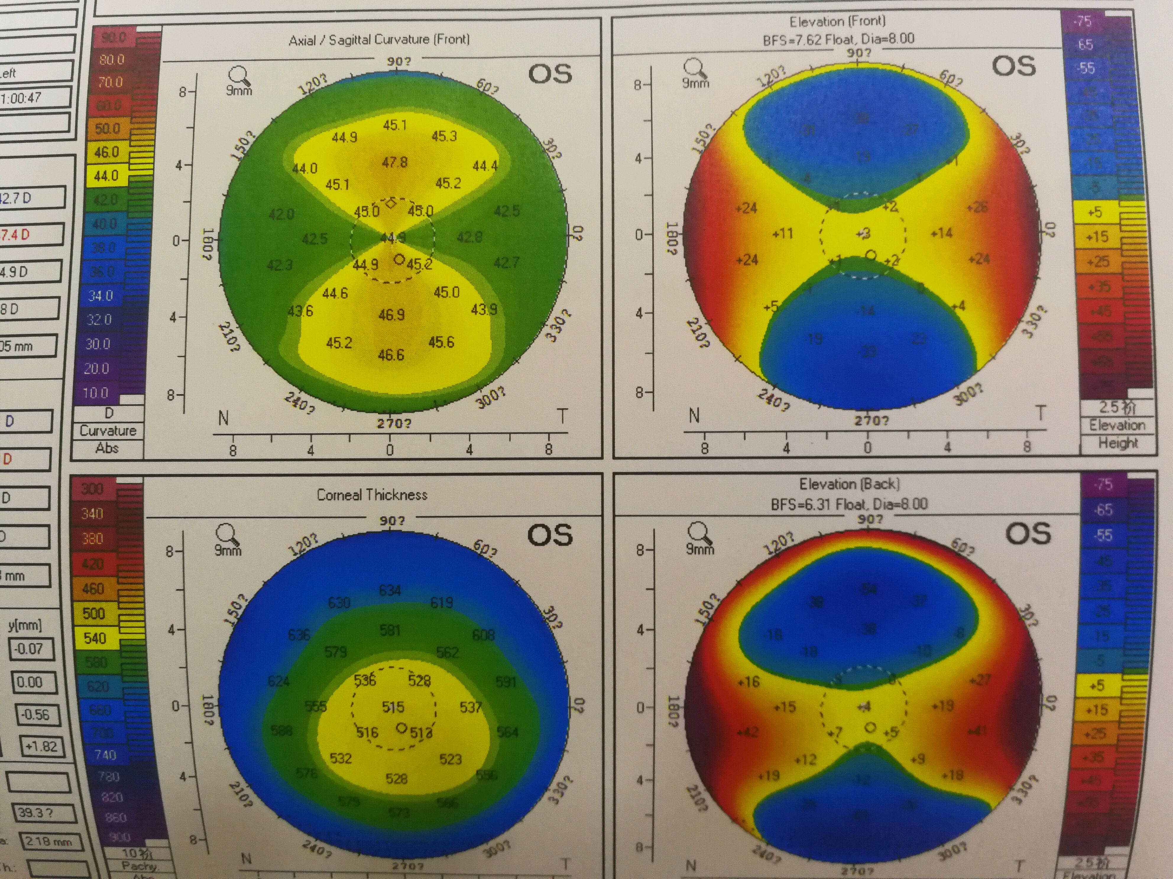 好久没见这么特殊的病例了,中度近视合并高度散光,角膜厚度还不足500