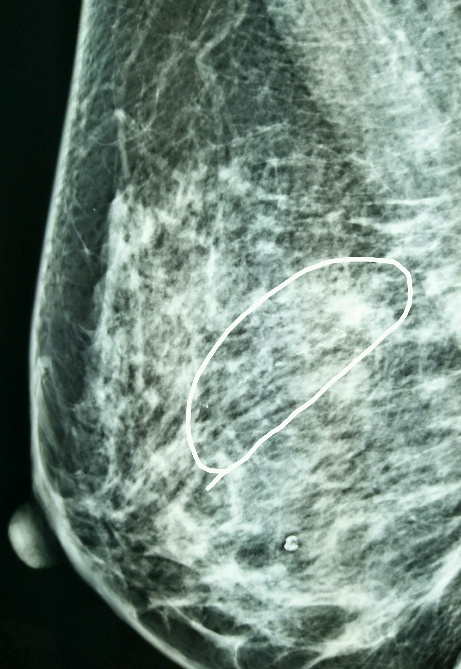 又是一例比较典型的乳腺癌