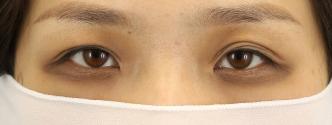 师丽丽眼修复丨双眼皮多层褶/多层眼皮可以进行修复吗?