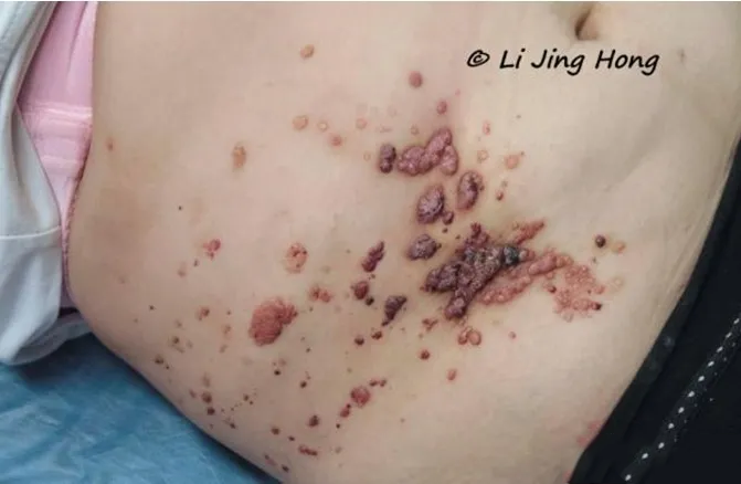 淋巴管畸形有哪些危害?