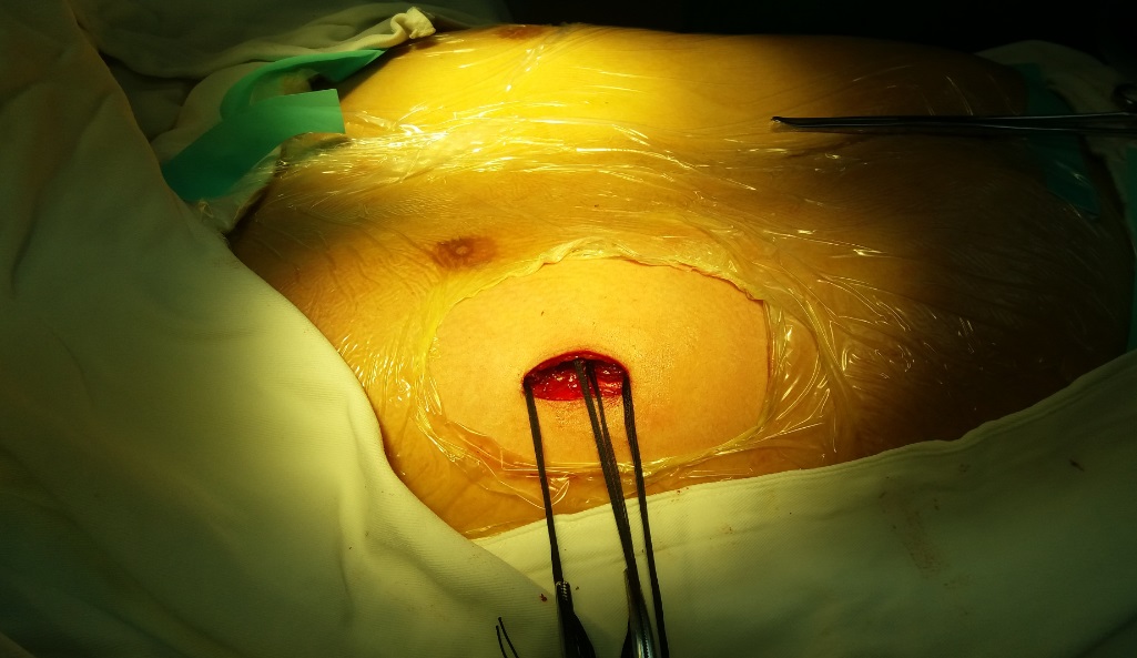 wang手术秘籍15公分微小切口中放3条钢板