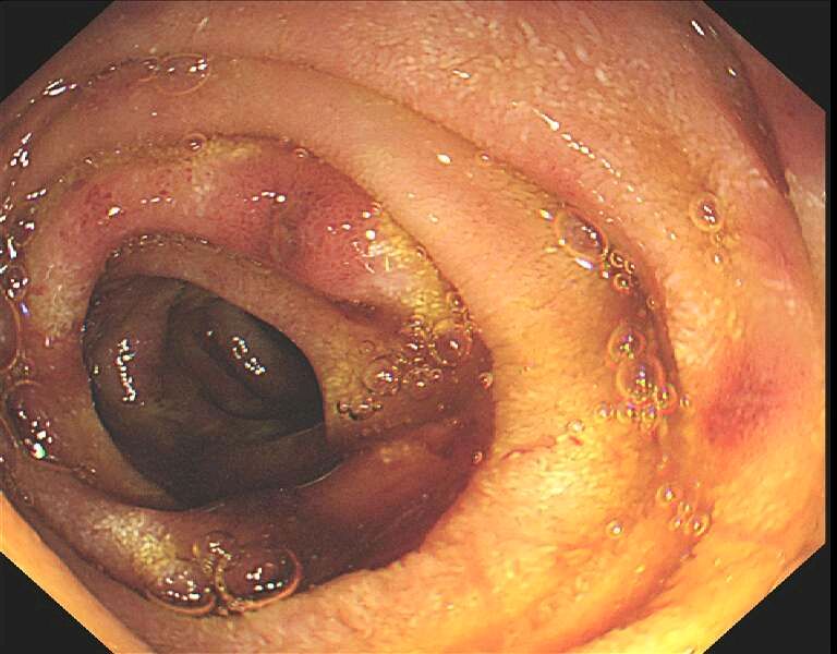胃镜十二指肠溃疡图片图片