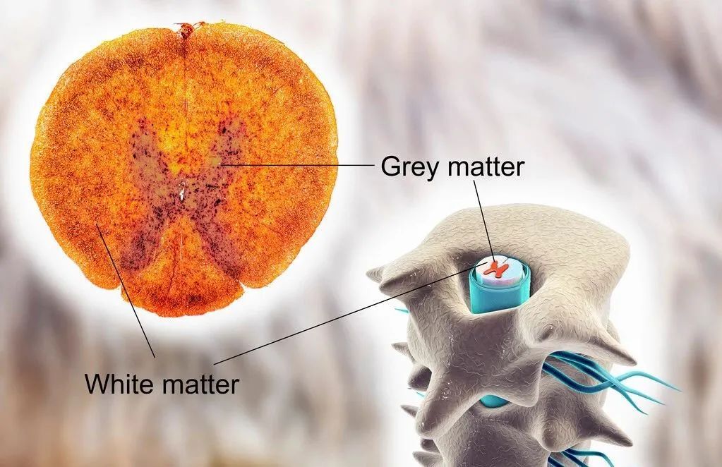 骨髓纤维化髓外造血危害极大,如何避免才是最重要的!