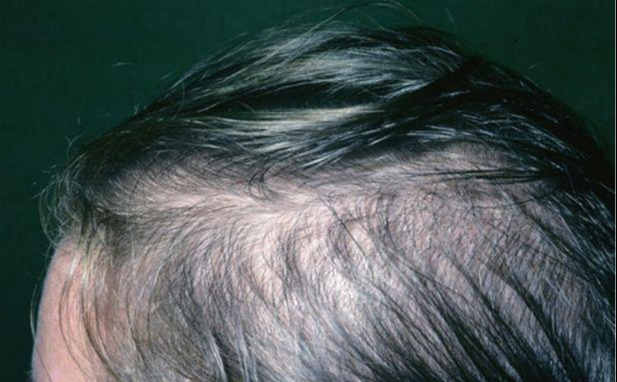 女性因为体内雄激素过高引起的脂溢性脱发怎么医治?