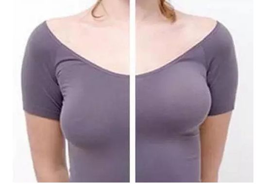 乳房下垂矫正术手术介绍乳房下垂双环法矫正术通过设计双环形切口,将