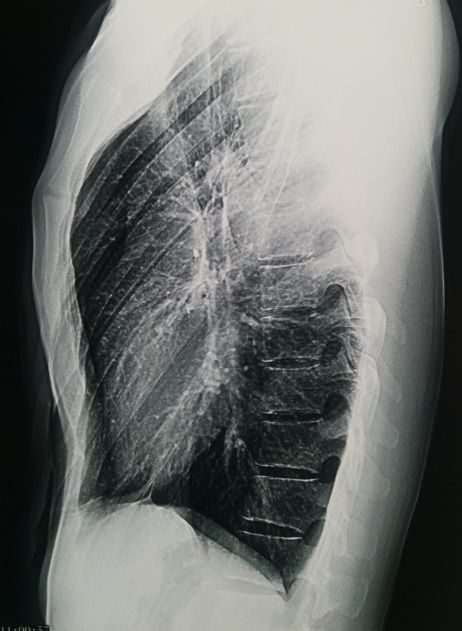 图2,x线显示胸廓宽厚.
