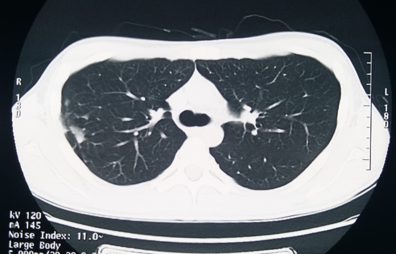 结核性胸膜炎后大面积漏斗胸合并扁平胸手术