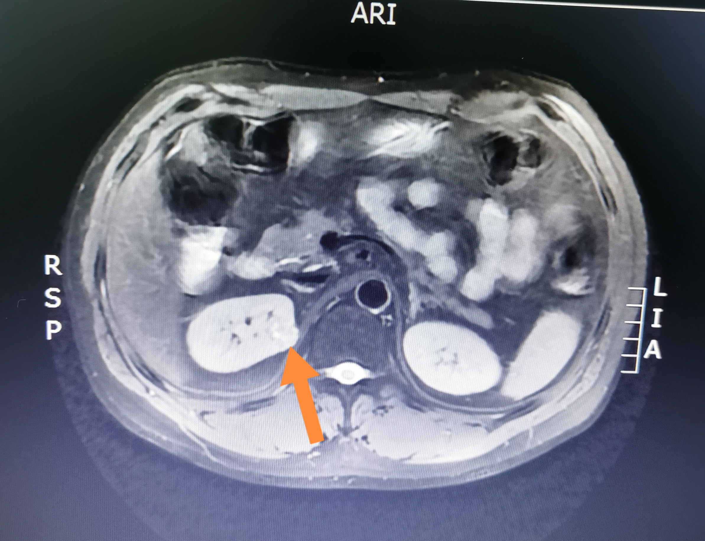 早期肾结节诊治体检和积极治疗的重要性