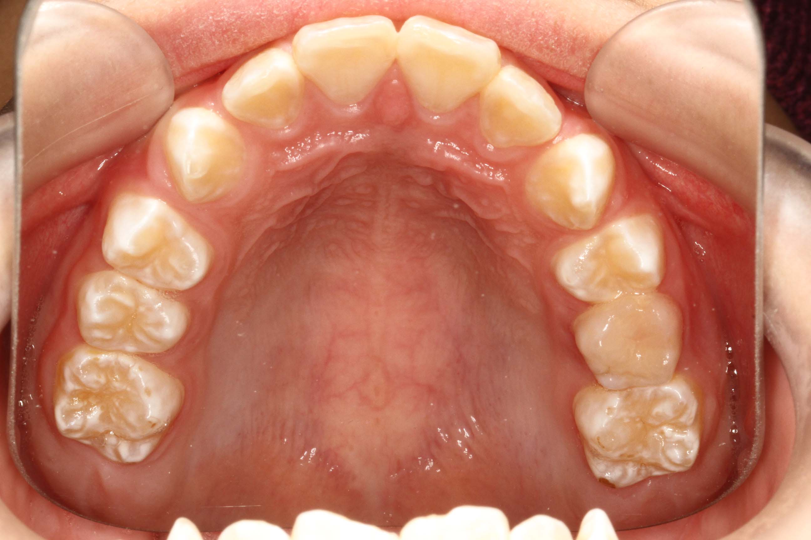 儿童龅牙的早期矫治——病因对策和双期矫治