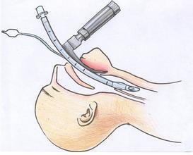 全麻(气管插管)术中是安全的,术后不一定是绝对安全的.