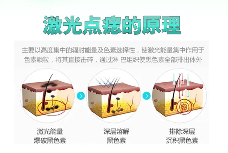 激光点痣好不好