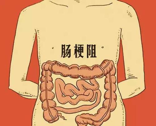 肠结核发病部位图片