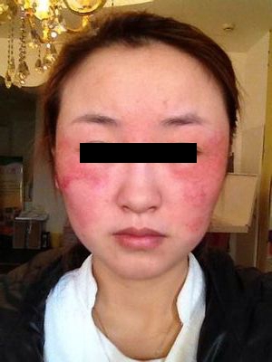 面部反复“过敏”，还能用护肤品吗？