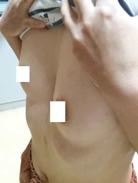 女性漏斗胸患者的第三次手术成功 医生说 39健康网