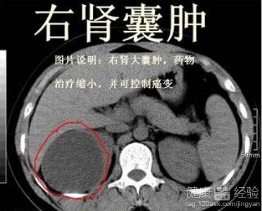 其中有個機構告訴他,不用手術,不用吃藥,喝茶就能治療腎囊腫,而且沒