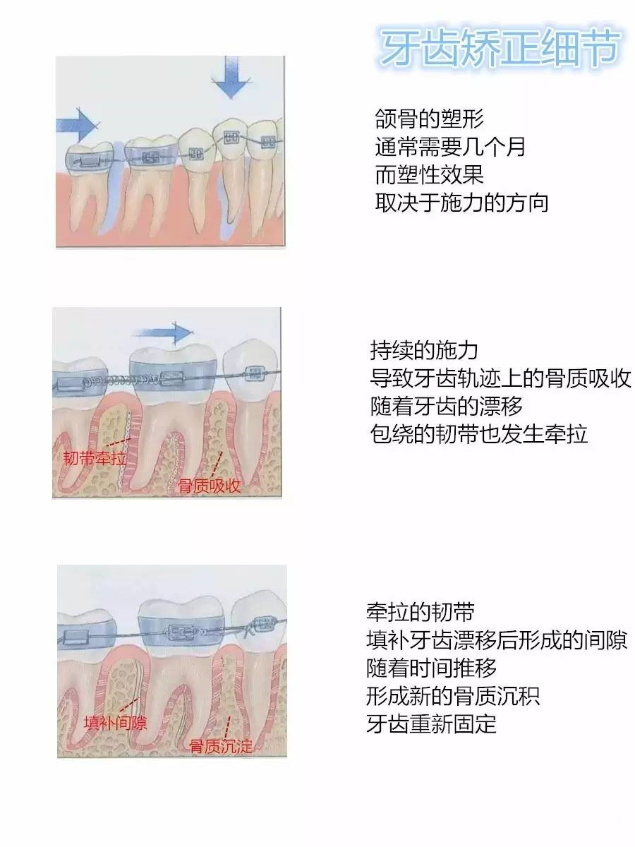 成人牙齒矯正沒有年齡限制