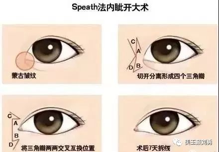 此方法类似于五瓣法(musta-de 法),改良的"m"成形术,"v-w"或"y-w"成形