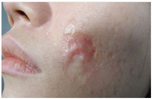 疤痕是皮肤胶原纤维异常增生的产物,脸上皮肤层比较薄,一旦随着增生物