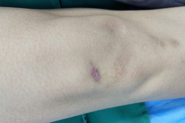 3厘米增生性疤痕险毁女孩空姐梦