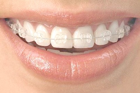 无托槽矫正几乎完全隐形,会让患者在别人毫无察觉中完成牙齿矫正,解决