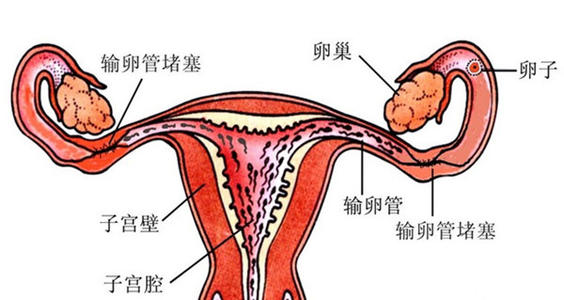 输卵管堵塞自查方法图片