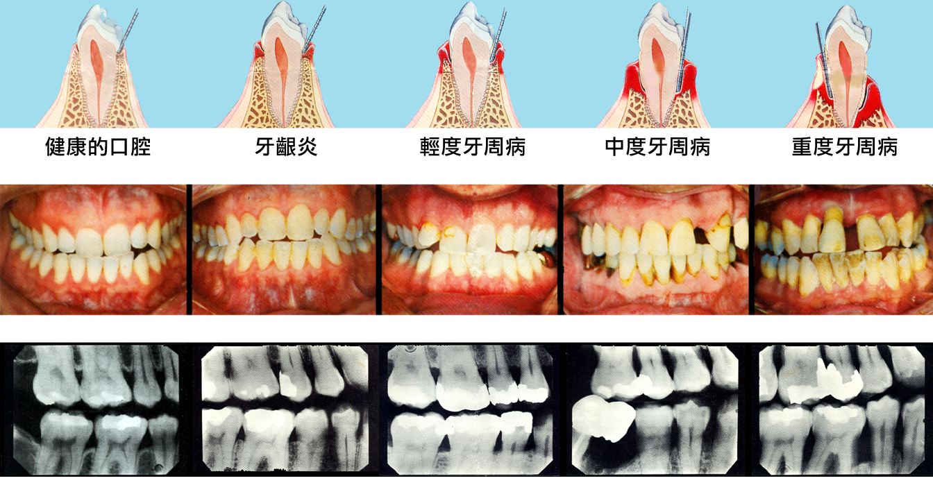 牙周不好就不能矫正牙齿,这是真的吗?