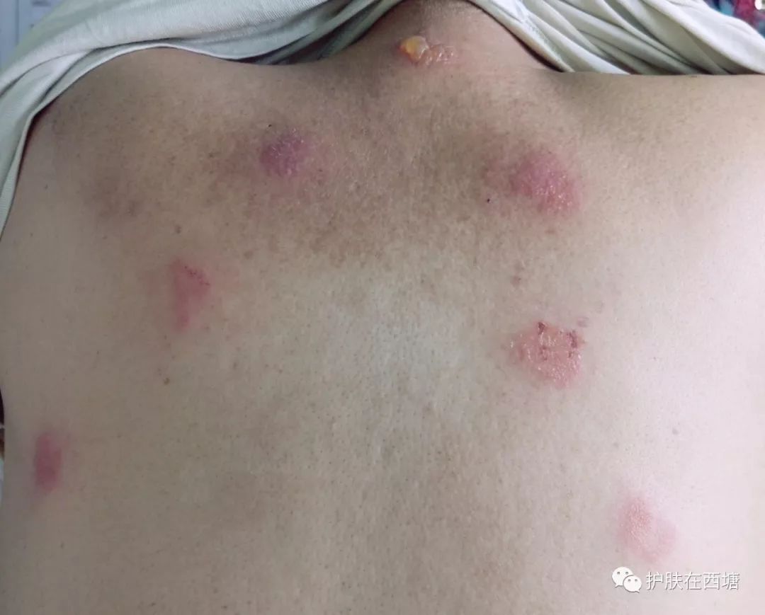 性的红肿溃烂,瘙痒明显,则应尽早医院就医,需要系统抗感染,抗过敏治疗