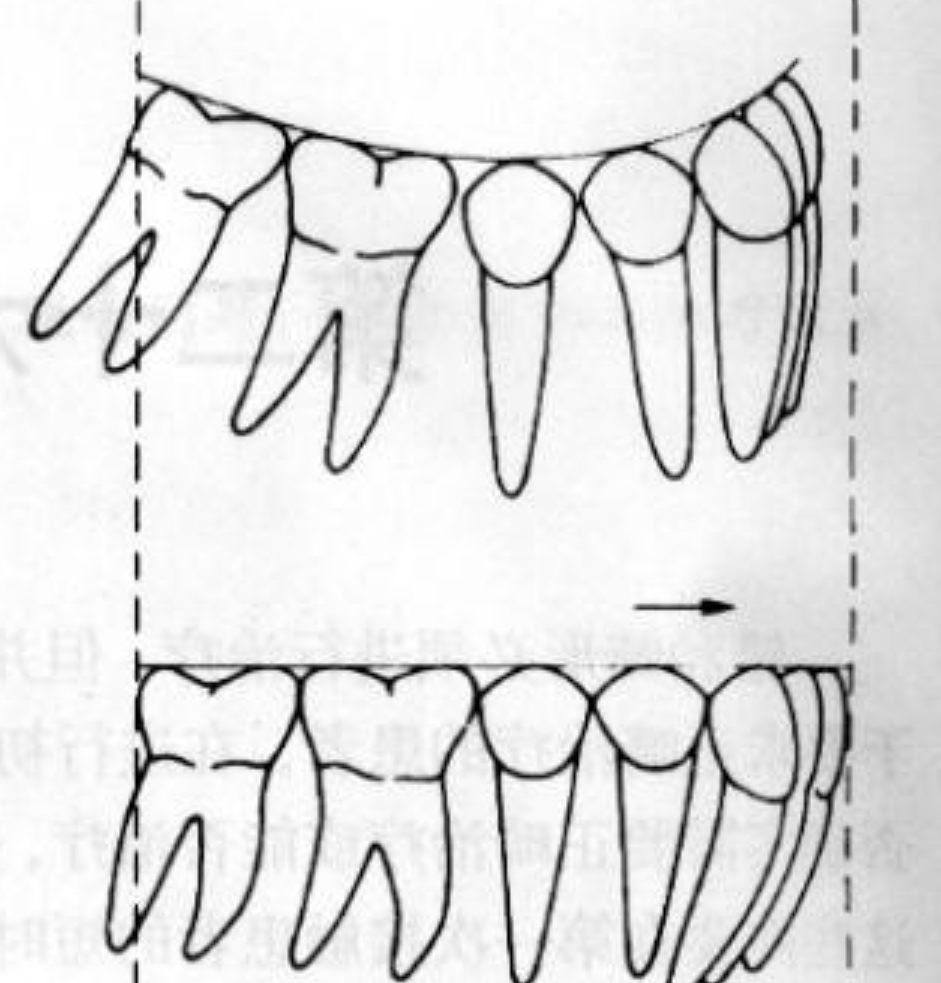 牙齿矫正:矫正间隙的获得
