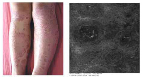 银屑病重要的检查诊断设备皮肤镜仪器