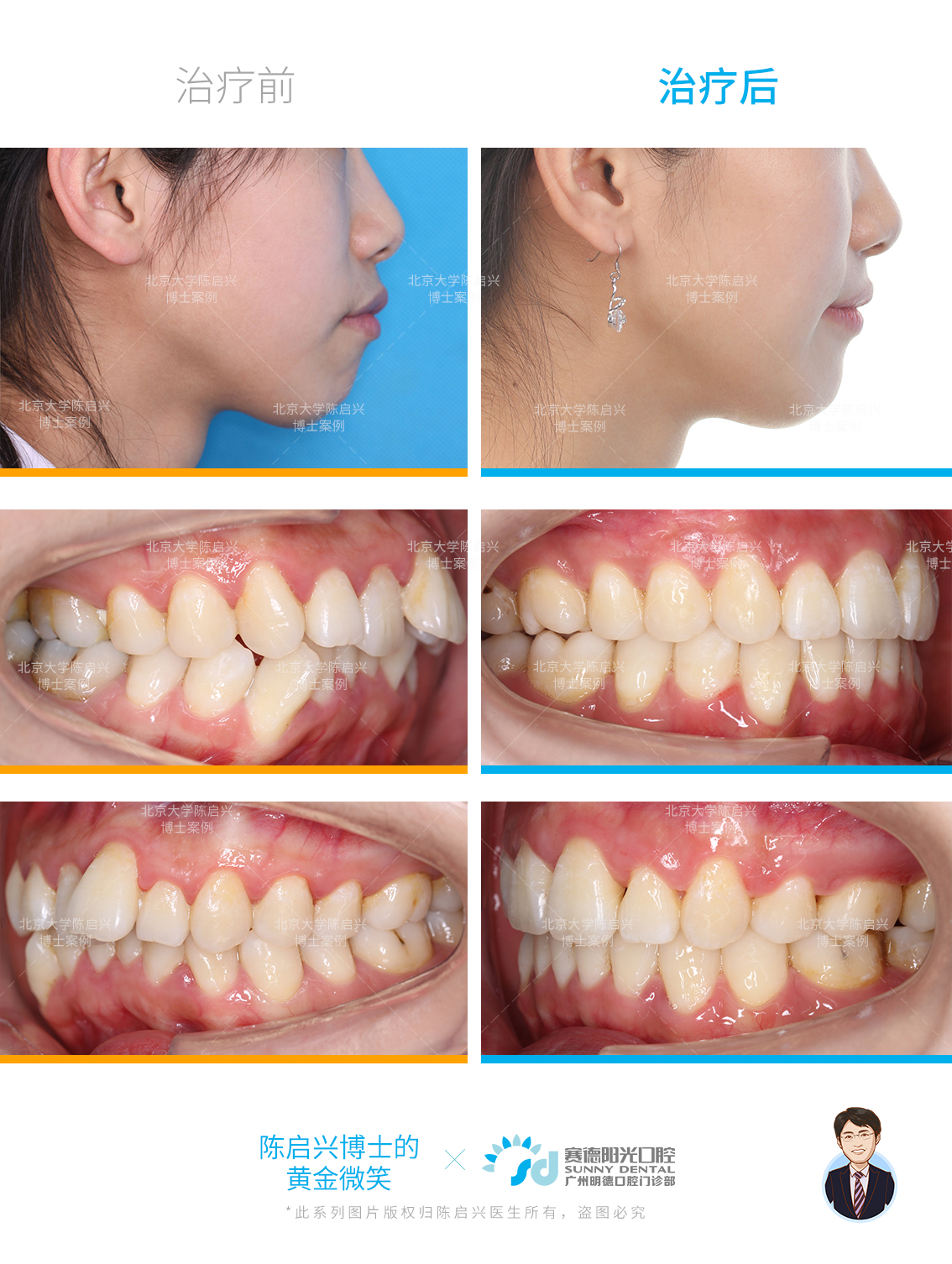 智齿代替磨牙的骨性龅牙矫正案例