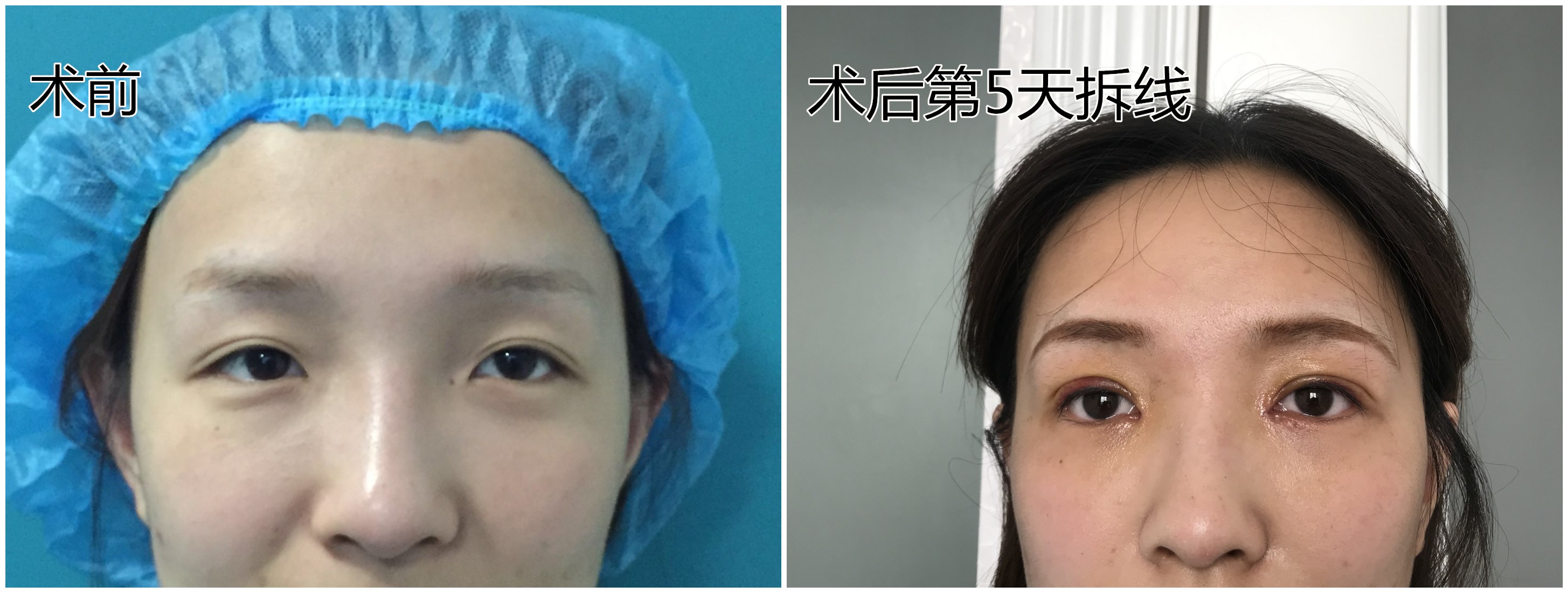 【诊间日记】重睑修复, 内眦开大术后14天