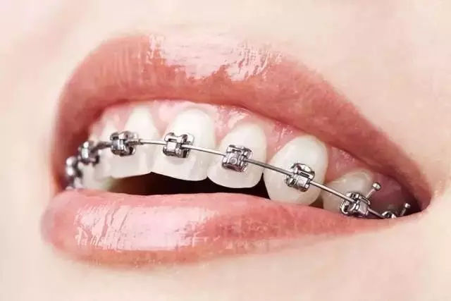 牙套是什么样子的图片图片