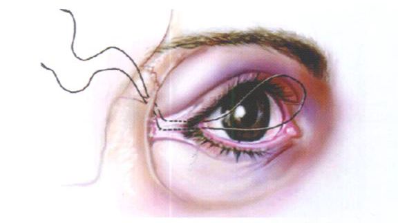 外眦锚着术在下睑退缩修复中的应用