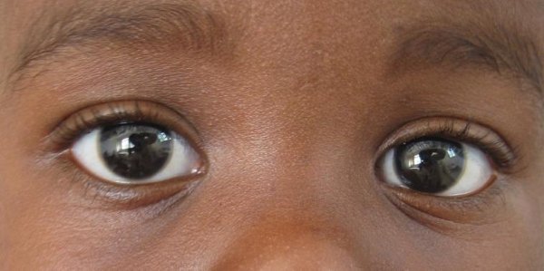 这是我年龄第二小的小患者,却是我眼睛最大的小患者,他给我的第一印象