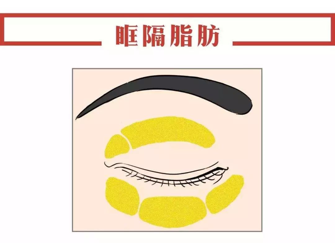 什么是眶隔脂肪释放术?