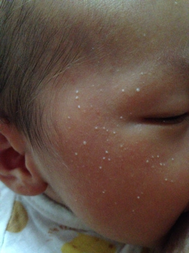 宝宝脸上的白色小点点新生儿粟丘疹milium