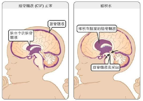 寶寶先天性腦積水是什麼原因造成的