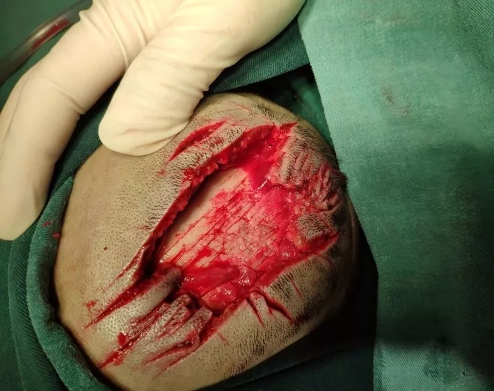 紧急手术治疗一位用菜刀砍伤头部患者