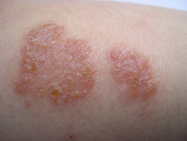 有时和接触性皮炎,虫咬性皮炎,儿童丘疹性肢端皮炎临床症状较相似,要