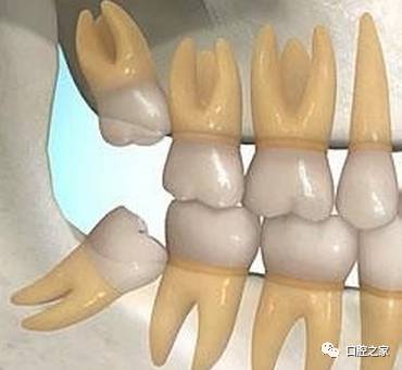 有一种牙齿,在失去之后,往往并不建议补上,那就是口腔最里面的牙齿,即