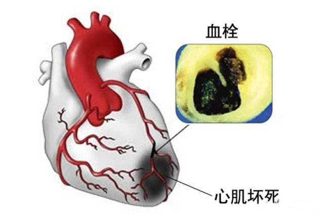 心脏介入医师说心梗支架术后应该注意什么