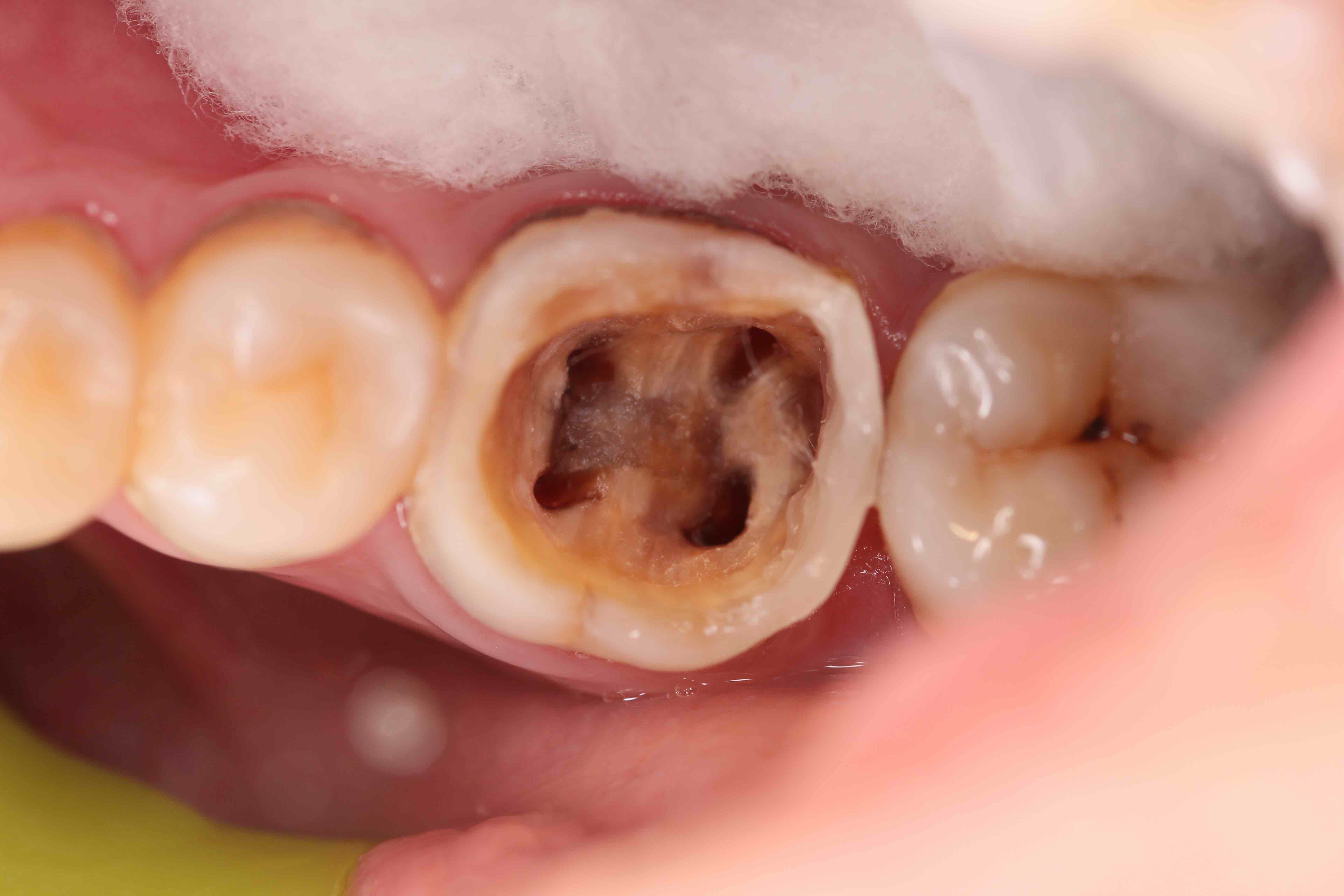 臼齿龋齿图片